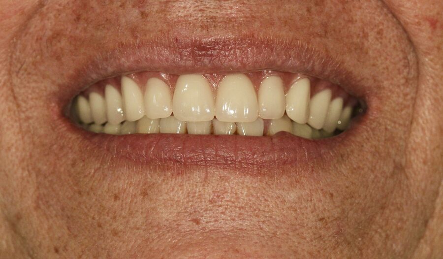 Después del tratamiento de coronas de porcelana, sonrisa renovada