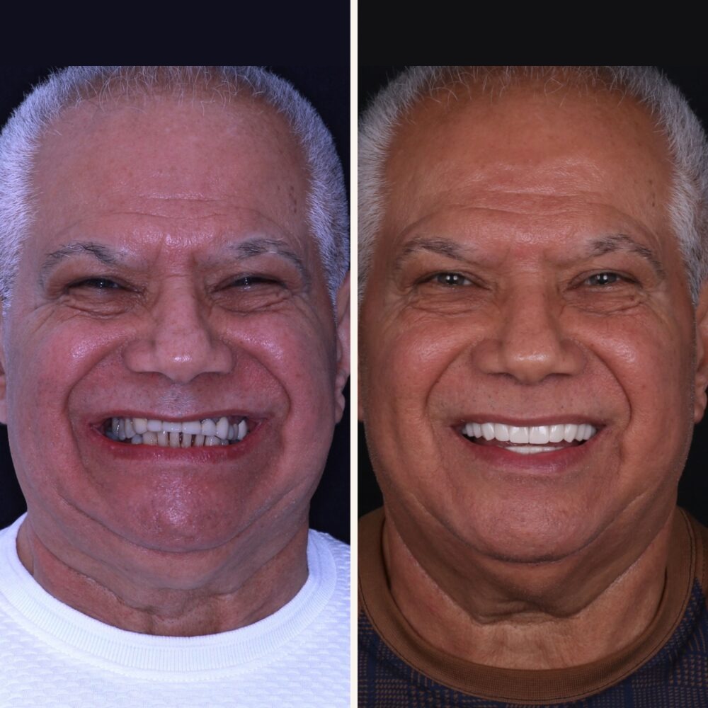 Caso real de rehabilitación oral, antes y después