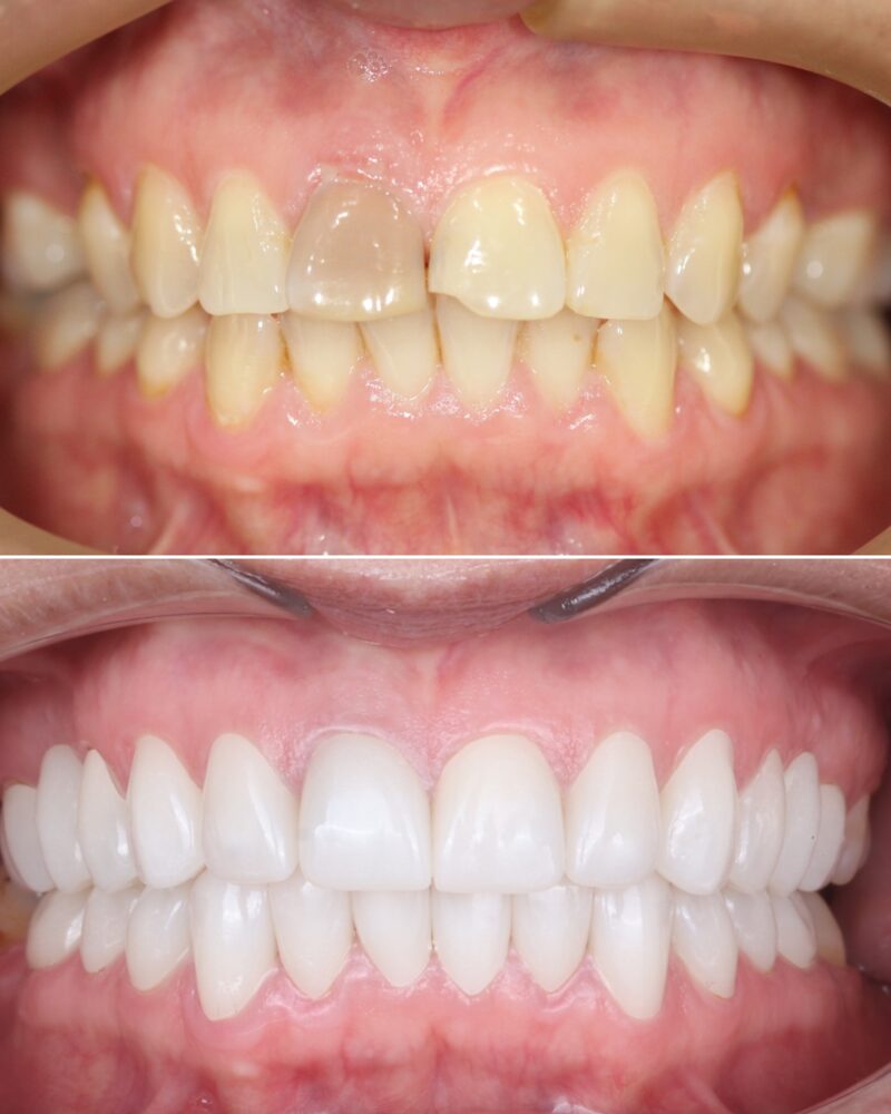 Caso real de diseño de sonrisa, antes y después