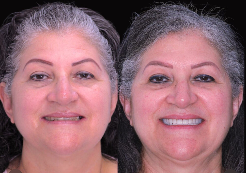 Caso real de implante dental, antes y después
