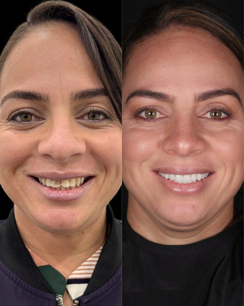 Caso real de coronas de zirconia, antes y después